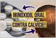 Minoxidil oral contra calvície os benefícios e os riscos envolvido
